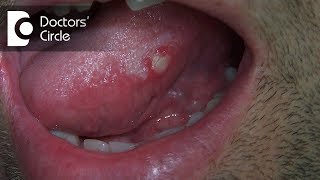 What are different circularlesions present on tongue  Dr Jayaprakash Ittigi [upl. by Eelsnia795]