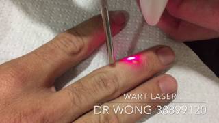 Laser to get rid of warts on Finger [upl. by Mazman315]