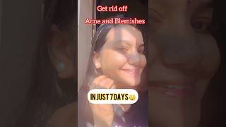 Home Remedy To Get Rid Of Acne and Blemishes in Just 7 Days😲 ytshorts acne viralshort skincare [upl. by Materi]