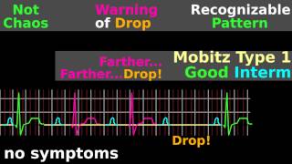 ECG Tutorial AV block EKG Mobitz electrocardiogram interpretation [upl. by Daggna]