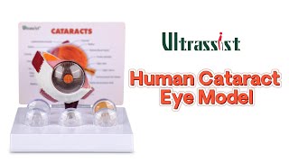 Enlarged Human Cataract Eye Anatomy Model for Ophthalmology Education [upl. by Naharba]