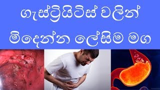 How to get rid of gastritis completely  Gastritis sinhala online learning [upl. by Julienne]