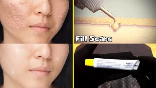 GET RID OF ACNE SCARS MEDICATED GEL ALSO EFFECTED ON PIMPLES URDU HINDI [upl. by Adnilam]