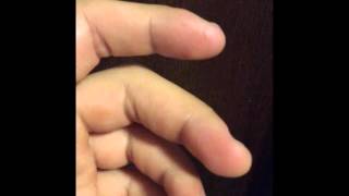 Major fasciculation in middle finger  Muscle twitching [upl. by Yur881]