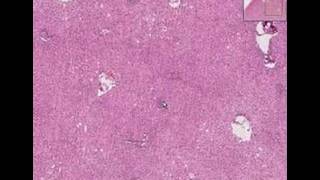 Histopathology LiverViral hepatitis [upl. by Brigette]