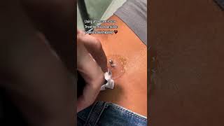 Piercing Migration Treatment  Piercing Bump Removal ft Base Laboratories Piercing Bump Treatment [upl. by Liesa]