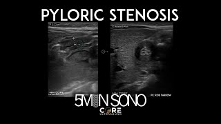 5 Minute Sono  Pyloric Stenosis [upl. by Nimra]