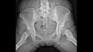 Osteoarthritis of hip [upl. by Cirala]