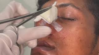 POST SURGICAL NASAL PACK REMOVAL [upl. by Ykcor]