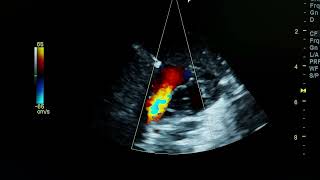 patent foramen ovale PFO ultrasound [upl. by Pik]