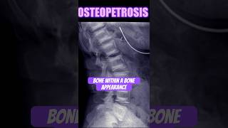 Osteopetrosis bones radiology doctor [upl. by Saiff867]