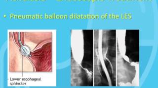 Treatment of Achalasia [upl. by Jacinto]