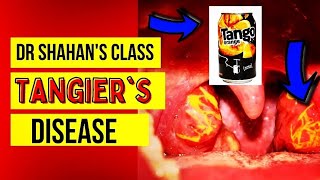 Tangiers Disease  Tango  haha 🤭  Mnemonics and explaination [upl. by Haldas398]