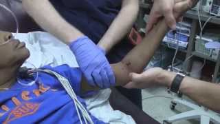 Posterior Elbow Dislocation Reduction [upl. by Ettevey]