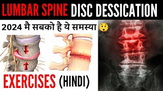 Disc desiccation with diffuse disc bulge  L4L5 L5S1 Low back pain पैरो मै दर्द  सुन्नपन जलन [upl. by Melina]