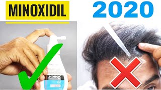 How to use Minoxidil properly  Use this way to get best Minoxidil Results [upl. by Neerbas]