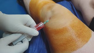 Knee fluid removal  Arthrocentesis  Synovial fluid aspiration procedure [upl. by Maitund659]