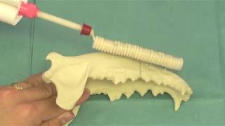 Acrylx ESF Acrylic  Mandibular Fracture Repair [upl. by Seel393]