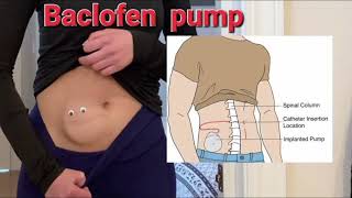 Baclofen pump mrcpch Communication [upl. by Ailati]