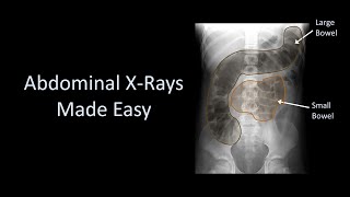 Abdominal XRays Made Easy [upl. by Birkett]