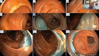 Serrated Colon Lesions How Best to Manage [upl. by Natsirk552]