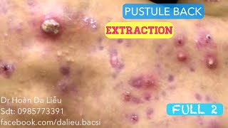 Mụn trứng cá mủ lưng cực nặngDermatologistpimpleswhiteheadacne conglobata pustule extrqction 2 [upl. by Mandeville]