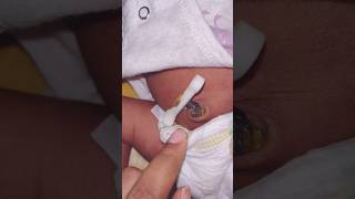 Yes newborn belly button look like this [upl. by Heath]