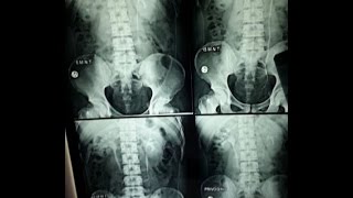 IVPIVU Intravenous UrographyPyelography BASICS OF RADIOGRAPH EXPLAINED [upl. by Ardnwahsal717]