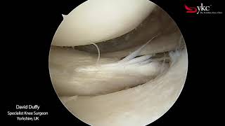 Watch a Knee Surgeon Treat a Meniscal Tear [upl. by Rosy647]