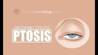 Drooping Eyelids  What causes Ptosis and How is it Treated [upl. by Gottfried417]