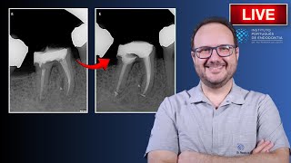 Endo Rtx of 🦷46 with furcal perforation ▶️ Single Session  CASE176 [upl. by Gerhardine74]