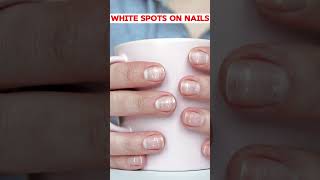 White Spots on Nails Causes and Solutions [upl. by Nylsirk]