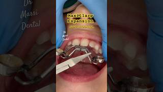 Maxillary Expansion Orthodontic Devices [upl. by Westfahl]