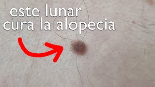 DESCUBRIMIENTO REGENERA tu PELO con tus LUNARES  OSTEOPONTINA [upl. by Kcirtapnhoj442]