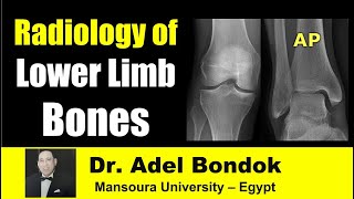 Radiological Anatomy of the Lower Limb Bones Dr Adel Bondok [upl. by Psyche556]