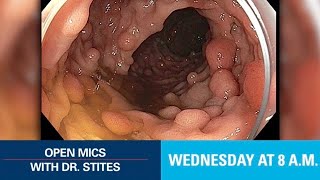 Open Mics with Dr Stites  Familial Adenomatous Polyposis [upl. by Aneeled]