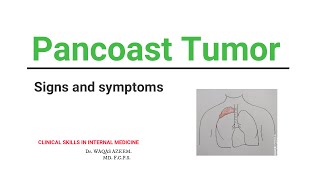 Pancoast tumor Signs and symptoms and treatment [upl. by Tnomyar]