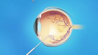 Macular Pucker Vitrectomy Surgery [upl. by Vas]