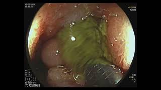 Subocclusion Treated by Colonic Stent Placement [upl. by Radu]