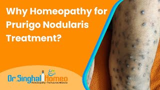 Homeopathic Treatment for Prurigo Nodularis with Effective Results  Dr Singhal homeo HomeoDoctor [upl. by Sedberry]