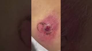 Back abscess with pus [upl. by Znarf]