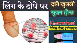 लिंग पर दाने खुजली सूजन इन्फेक्शन का दवा  balanitis medicine  gonorrhea  STD infection [upl. by Etteluap]