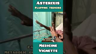 Asterixis  flapping tremors made simple for USMLE NEET PG NCLEX neet usmle medical doctor [upl. by Nnov]