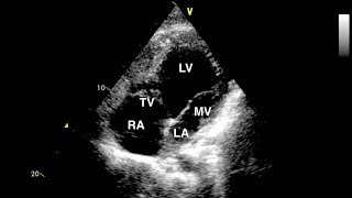 Double Inlet Left Ventricle Echocardiogram [upl. by Gilles]