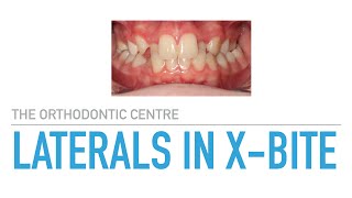 Orthodontic Treatment of Anterior Xbite at The Orthodontic Centre [upl. by Notlehs]