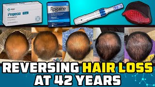 He Let Himself Go Bald Then At 42 He Tried Reversing It And This Is What Happened [upl. by Yelwar156]