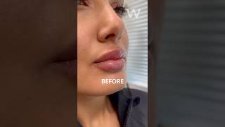 Before and after Restylane Kysse Lip Filler results with Dr Wise for a naturallooking plumped pout [upl. by Remmus]