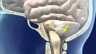 Brainstem Herniation [upl. by Orran]