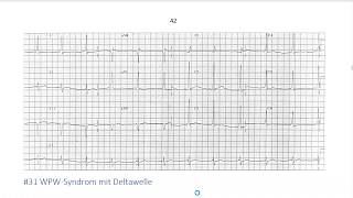 EKG in 3 Minuten 4 [upl. by Sorodoeht]