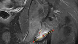 Fracture of ischial apophysis [upl. by Holton]